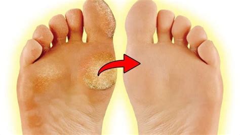 Apply this on feet after having a bath. By Using These Ingredients For To Remove The Calluses On ...