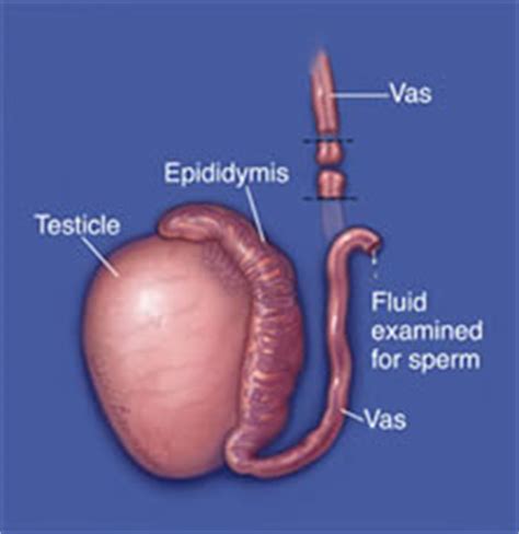 How is vasectomy done in men? Vasectomy reversal. Causes, symptoms, treatment Vasectomy ...