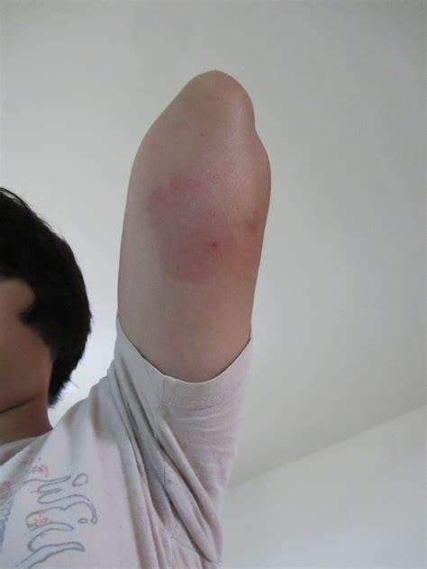 Skeeter syndrome is an allergic reaction caused by polypeptides that are found in mosquito saliva. Displaying 19> Images For - Mosquito Bite Allergy Skeeter ...