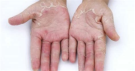 Gejala yang muncul bisa berupa sakit punggung disertai dengan. Bisul: Punca, Komplikasi dan Cara Rawatan - The Diagnosa