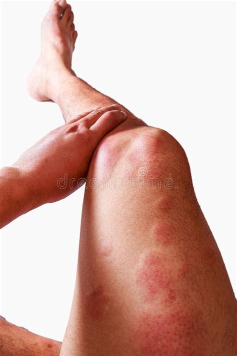 If you're allergic to cow's milk, your immune system will overreact to the protein in milk. Around Legs And Hands Of Man With Dermatitis Problem Of ...