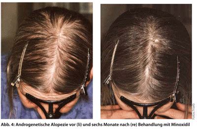 This patchy baldness can develop anywhere on the body, including the scalp, beard area, eyebrows, eyelashes, armpits. Haarausfall bei Frauen - Ursachen und Behandlung ...