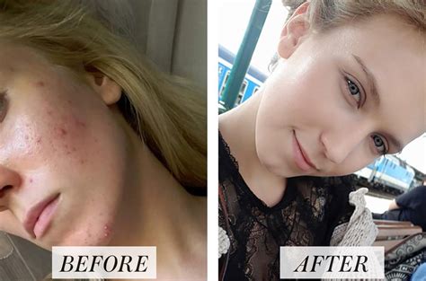 While i have yet to try the face foundation, i did try the leg and body makeup. Woman's Before and After Accutane Photos Go Viral on ...
