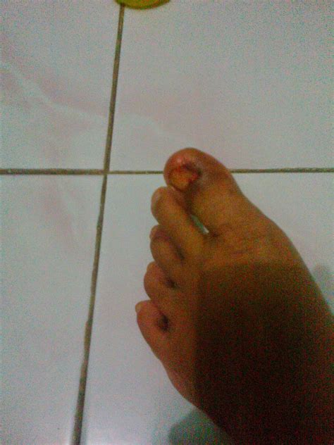 Jempol Kaki Bengkak dan Bernanah - Andriyatna's Blog ...