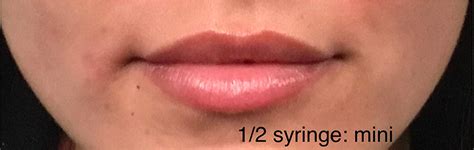 Most lip plumping injections will require a single one cc syringe, and the prices will depend on where you live, the doctor you choose and what type of injections your doctor is using. Lip Injections Tucson | Lip Augmentation Tucson