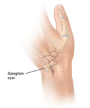 A lump on the back of the leg may indicate the achilles tendon fibers have begun to break down, swell, and thicken. Ganglion Cyst Hand | Articles | Mount Nittany Health System