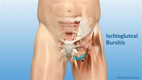 However bursitis is a long term condition usually caused by repetitious actions. Rosalopa: Pipi