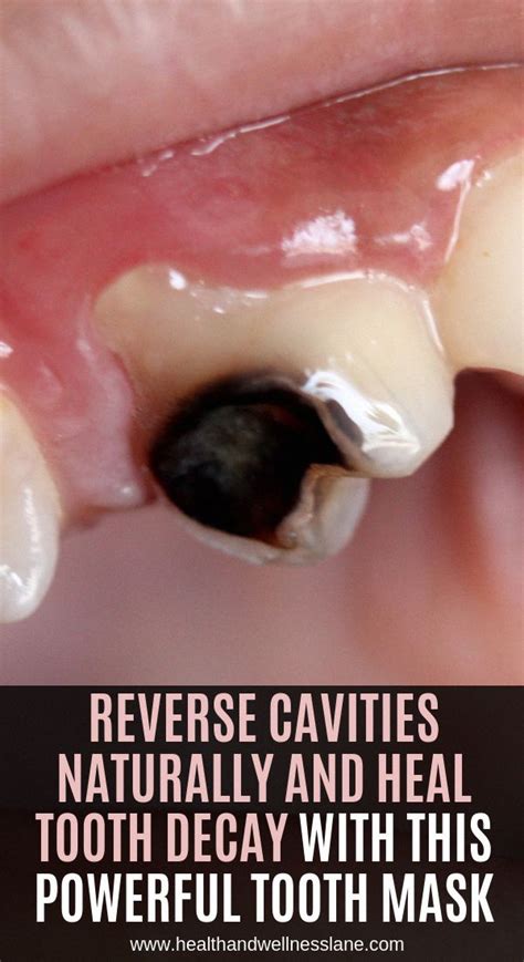 This is a process known as 'tooth remineralization'. Reverse Cavities Naturally and Heal Tooth Decay with THIS ...