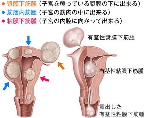 子宮穿孔 / 子宫穿孔 ― zǐgōng chuānkǒng ― uterine perforation. 婦人科豆知識：子宮筋腫 ｜ さがらレディスクリニック