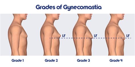 Breast cancer symptoms in males. Breast reduction surgery quadruples among british man ...