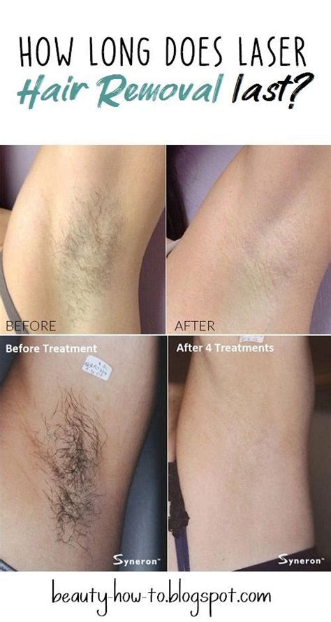 It's common for many nurses and women in healthcare professions to get training in laser hair removal, but spas can offer the same thing. How long does laser hair removal last? | Laser hair, Laser ...