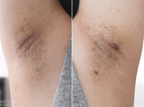 After each treatment fewer hairs grow back, and what does grow back grows slower, lighter and finer. tria Hair Removal Laser 4X & SmoothStart Calming Gel ...