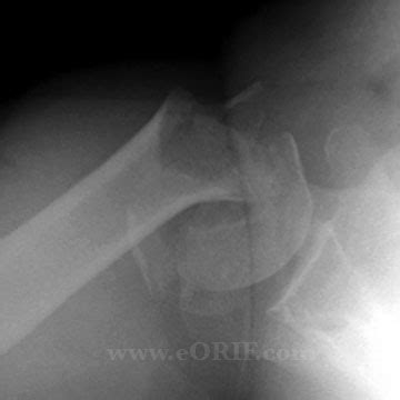 Proximal Humerus Fracture Hemiarthroplasty Cases | eORIF