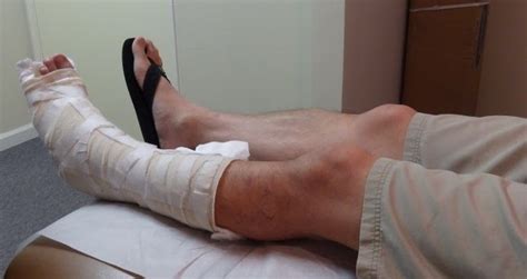It'll keep your foot in a pointed position. Run Lily Run: Ruptured Achilles Tendon - Day 24, Post Op ...
