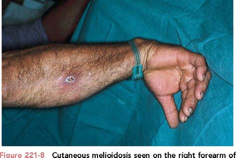 Melioidosis most commonly occurs in southeastern asia and northern . PDF 223 - Burkholderia pseudomallei and Burkholderia ...