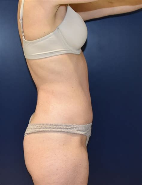 Till the date, she has not disclosed information about her father and mother. Tummy Tuck Before and After Photos by Richard Reish, MD ...