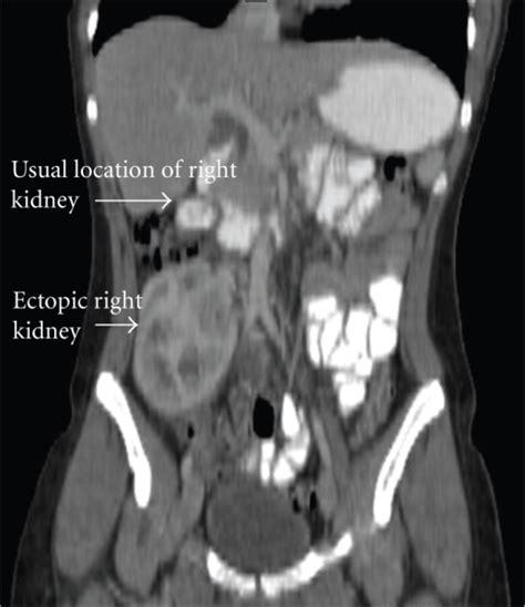 Discover the symptoms, causes, and treatments of breast cancer today. Coronal view right ectopic kidney. The right kidney res ...