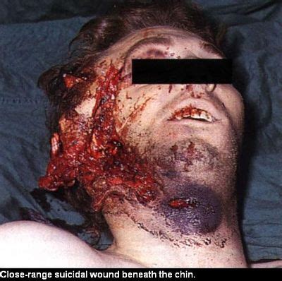 The human body is an amazing thing. Suicidal Gunshot Wounds to Heads