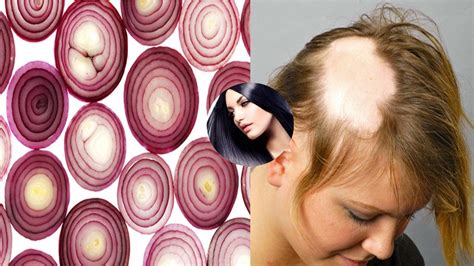 In combination with coconut milk, it conditions your hair 2. Grandma's SECRET Recipe for Hair growth in 15 days Onion ...