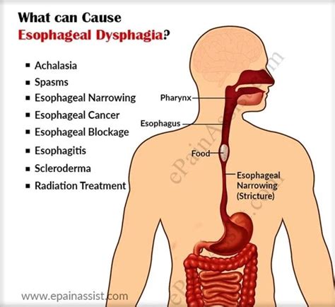 You could be having an anaphylactic reaction, even if you don't have known food allergies. What Causes Dysphagia and How is it Diagnosed and Treated ...