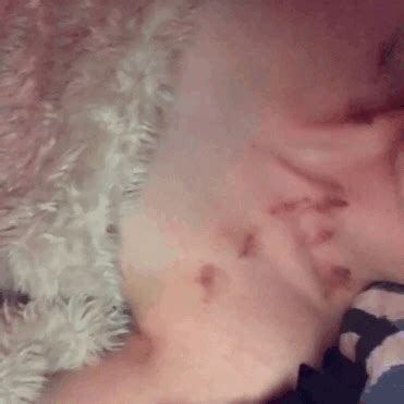 A small cluster of split veins on the neck from sucking. love bites on Tumblr