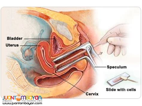 Detecting cervical cancer early with a pap smear gives you a greater chance at a cure. Pap Smear