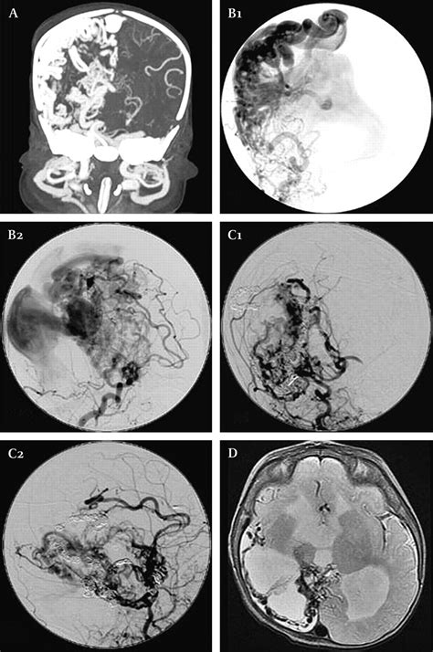 Neonatal giant pial arteriovenous malformation: genesis or ...
