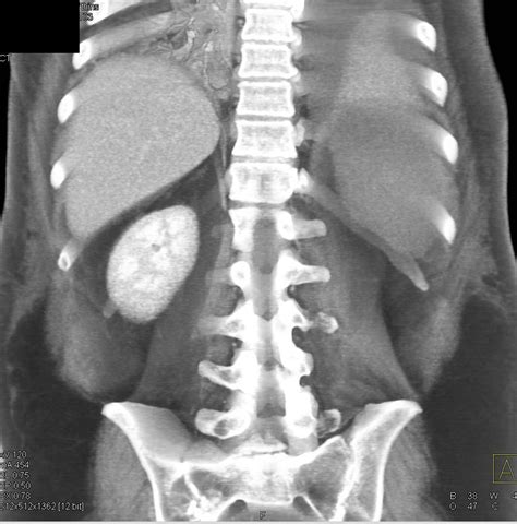 Radiological procedure 01916 dx arteriography 01920 catheterize heart 01922 cat or mri scan 01924 anes, ther. Post Whipple Procedure with Large Splenic Infarct ...