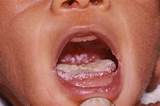 The first thing to check is whether you can brush or wipe the. Oral thrush (mouth thrush) - NHS
