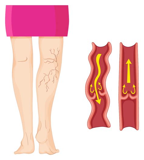 A trombose hemorroidária acontece principalmente quando se tem uma hemorroida interna ou externa que se rompe ou fica comprimida pelo ânus. Medcenter - Varizes têm relação com casos de trombose?