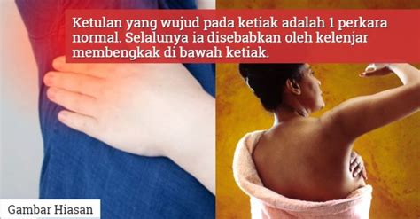 Ada beragam penyebab terjadinya benjolan di ketiak, di antaranya akibat infeksi bakteri, kista, iritasi, alergi akibat penggunaan deodoran atau . Bukan Sebab Kanser Sahaja, Ini Punca Lain Mengapa Muncul Benjolan Di Ketiak Anda