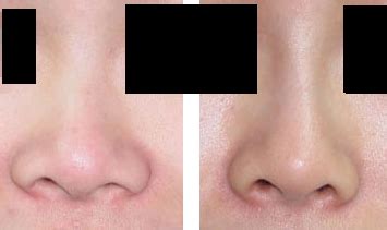 Sometimes he may seem to downplay his capability, but to be honest, i am very happy with the rhinoplasty outcome that he has performed on me. Plastic and Cosmetic Surgery with Dr Cheong You Wei ...