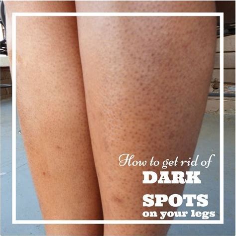 How to Get Rid of Dark Pores on Legs (Strawberry Legs ...