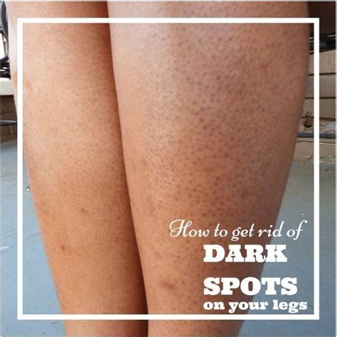 When this happens, the area can become irritated, causing redness and pus formation. coba notes that ingrown hairs. How to Get Rid of Dark Pores on Legs (Strawberry Legs ...