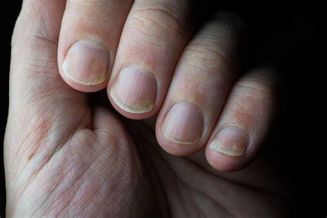 Zmiany na paznokciach: co oznaczają białe plamy, bruzdy i paski? Po ...