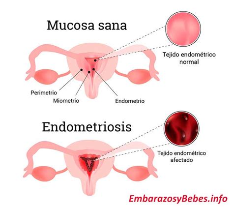 Endometriosis externa within the rectus abdominis muscle. ¿Endometriosis y Embarazo es Posible la Concepción?