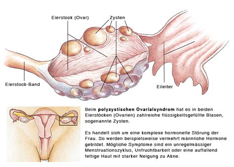 Kontaktdermatitis der genitalien kann durch folgende empfindlichkeit hervorgerufen werden: Polyzystisches Ovarialsyndrom, Polyzystisches Ovar - eesom ...