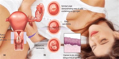 Feeling full too quickly or difficulty eating, bloating, and abdominal or back pain are common only for ovarian cancer. Cervical Cancer - Symptoms, causes and treats