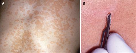 It is a fungal infection where an overgrowth of yeast leads. The BMJ Today: Thinking about common and not so common ...