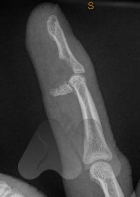 Occurs from forced extension of flexed dip (historically from grabbing someone's jersey with the tip of a finger). Jersey Finger - Avanthi Mandaleson