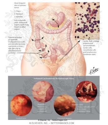 Peritoneal mesothelioma remains a rare primary disease of the peritoneum where survival advantage may be achieved through cytoreductive surgery and hyperthermic intraperitoneal chemotherapy over systemic treatment alone. Cancer peritoneal avanzado esperanza de vida ...