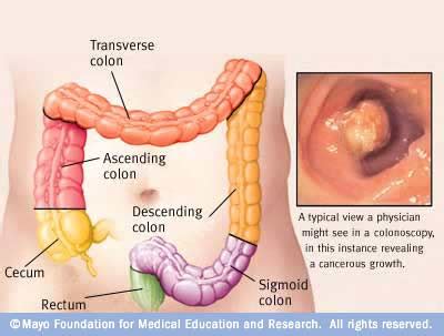Bowel cancer, sometimes called colon or rectal cancer, is a general term for cancer that begins in the large bowel. View of colon cancer | ENCOGNITIVE.COM
