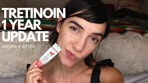 May 24, 2021 · tretinoin for acne: One Year Tretinoin/Retin-a Update | Before & After - YouTube
