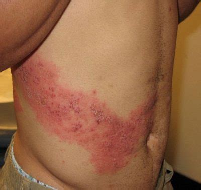 After effects of shingles - kumlead