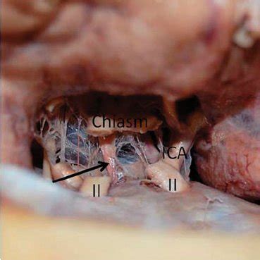 An essay conclusion is the next most important part after the introduction. (PDF) Relationship of Optic Chiasm to Sella Turcica and ...