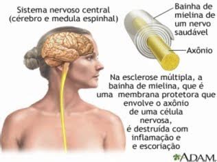 Na esclerose múltipla (em), o revestimento dos neurônios (mielina) sofre o ataque por células do um erro comum de alguns pacientes é aceitar os sintomas, especialmente os novos, como se não. TRATAMENTO COM CÉLULAS TRONCO É SUCESSO CONTRA ESCLEROSE ...