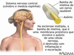 Não existe um sintoma típico que feche o diagnóstico de esclerose múltipla, porém. TRATAMENTO COM CÉLULAS TRONCO É SUCESSO CONTRA ESCLEROSE ...