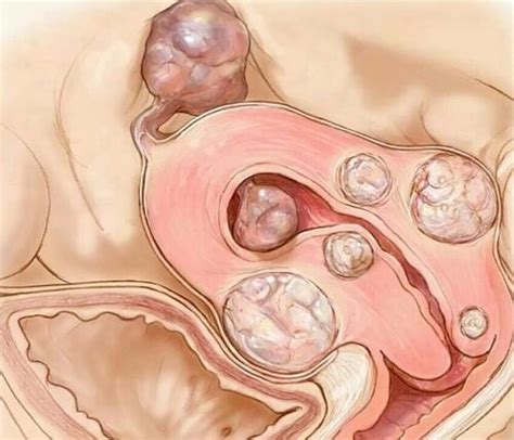 Il fibroma uterino è una formazione non cancerosa che colpisce le donne dal 20 all'80 per cento dei e di familiarità, tuttavia negli ultimi anni ci sono stati degli studi che hanno trovato un legame tra alimentazione e fibromi. Mioma uterino: 5 cose che bisogna sapere - Vivere più sani