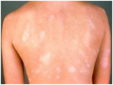 Bathe or shower in lukewarm water. Pityriasis Alba - Pictures, Treatment, Causes, Symptoms ...