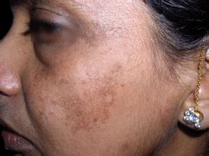 Asal ada individu yang mengadu sakit gigi, pasti nasihat ini akan ia kebiasaannya dijual dalam bentuk minyak pati dan boleh digunakan sebagai pengkumur mulut atau ubat sapu. Ceriakan Hidup Anda Dengan Cara Tradisional: 6 Petua ...